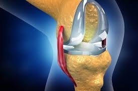 Joint Replacement